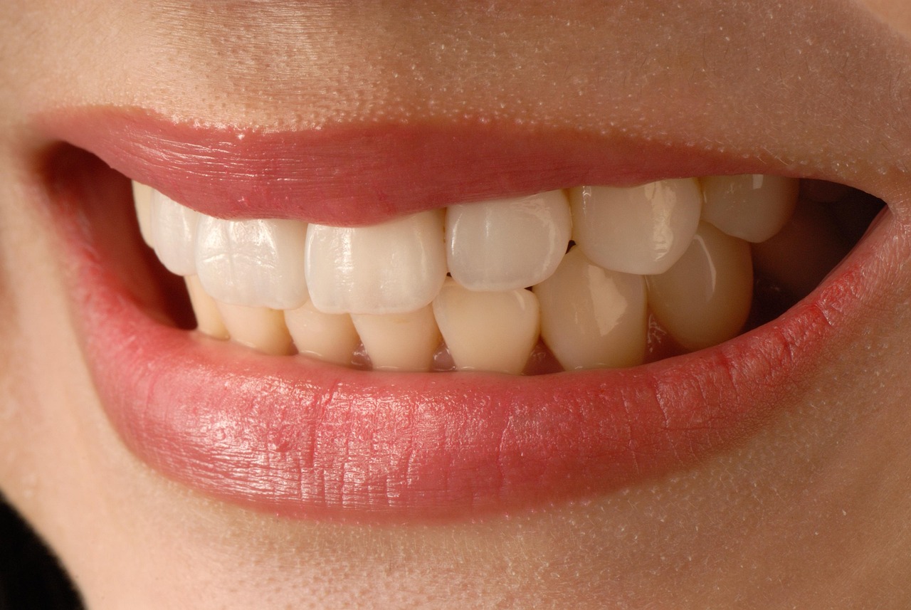 Dental Veneers treatment in Switzerland