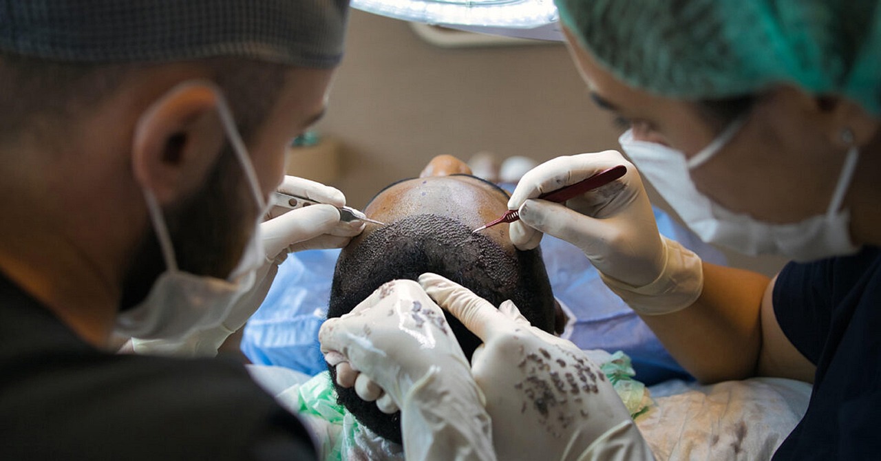 DHI Hair Transplant treatment in Switzerland